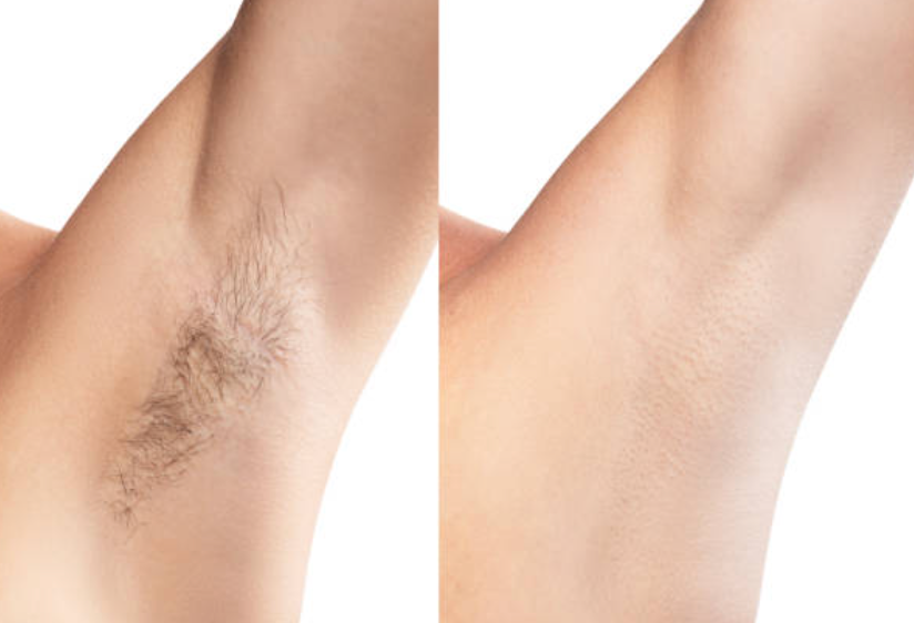 What is IPL Laser and How Effective is it?